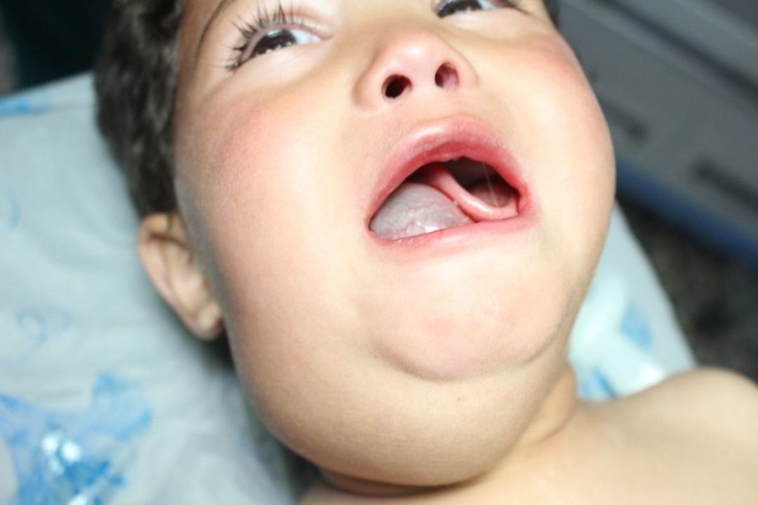 أطباء الشمال ينجحون بإجراء عمل...