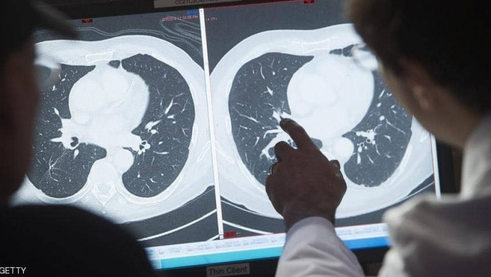 علماء يطورون فيروسا لقتل خلايا...